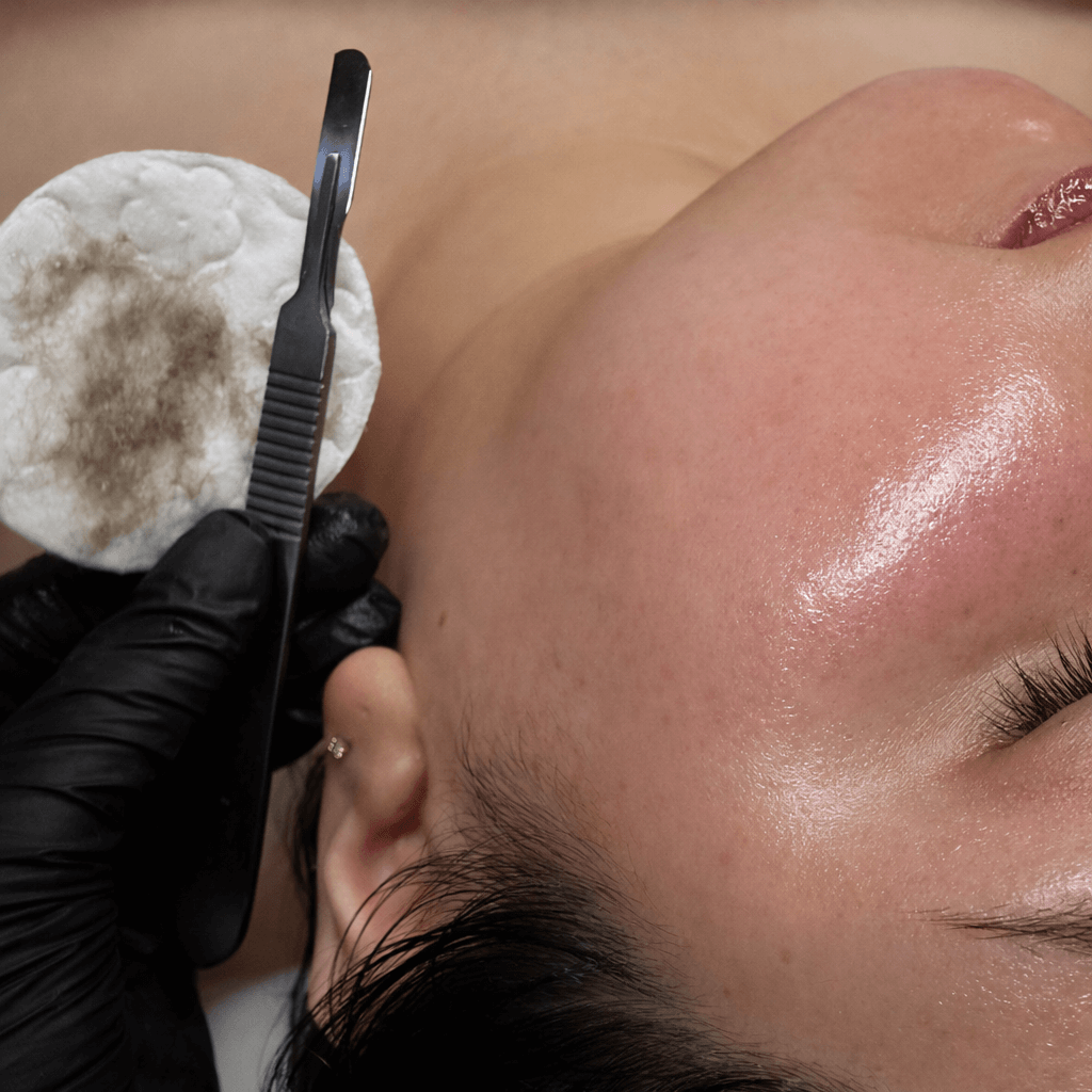 Dermaplaning Treatment